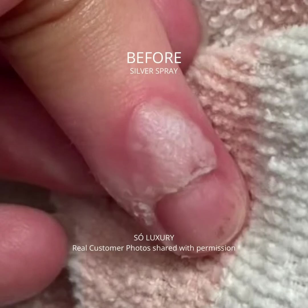 Video showing before and after photos of a wart on a finger that went away with the use of Silver Spray photos includes text Before / After Silver Spray and Só Luxury and Real Customer Photos shared with permission