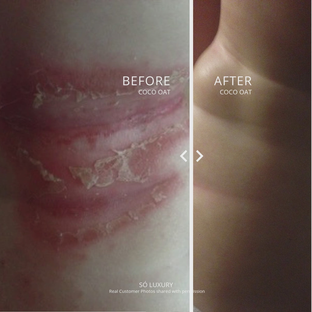 Before and After photos showing a severe rash before and clear skin after labelled with Before Coco Oat and After Coco Oat including a notation that Real Customer Photos shared with permission